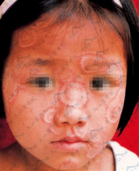 【附图】面癣：面部多数圆形及环状损害，边缘隆起，有红色丘疹、丘疱疹，炎症明显_皮肤病学 | 天山医学院