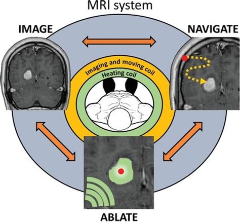 Advanced Science:科学家研发基于磁共振的微创图像引导消融系统 - 专区 - 生物谷
