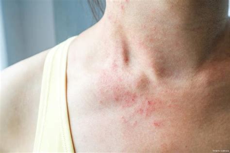 汗疱疹是什么原因引起（汗疱疹怎么治才能根除） | 说明书网