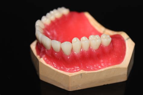 隐形义齿弹性义齿 成都口口齿科技术有限公司