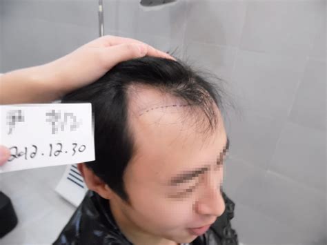 来看上海新生植发发际线种植效果图啦,1900单位两万多真不贵 - 爱美容研社