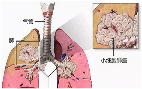 肺癌的诊断方法_有来医生