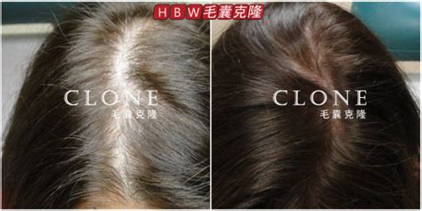 毛囊克隆技术成功引进，给无数脱发人群带来曙光 | 中国周刊