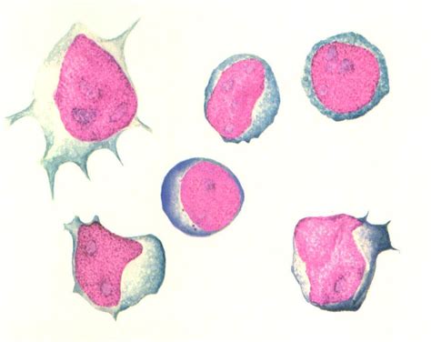 图112 幼稚型异型淋巴细胞(Ⅲ型)-血液学细胞学-医学