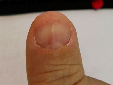 观察自己的手指甲，出现这种“竖条纹”，预示4种疾病可能出现了 - 知乎