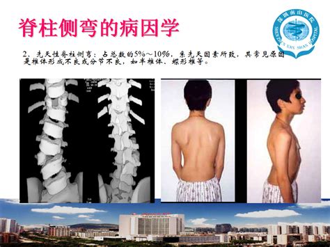 布骨医学科普：不同角度看脊柱——脊柱冠状面弯曲角度的测量,布骨医疗