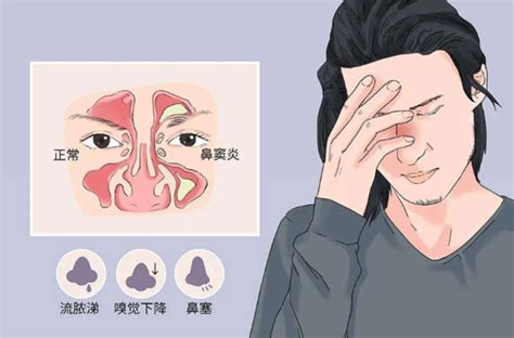 鼻炎与鼻窦炎的区别_360新知