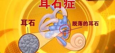 耳石症图片