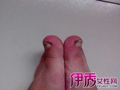 【脚大拇指指甲长肉里】【图】脚大拇指指甲长肉里是什么原因 有什么治疗方法？_伊秀健康|yxlady.com