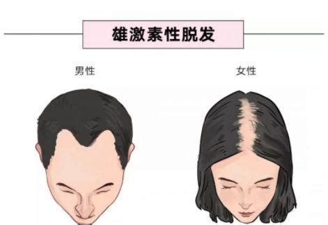雄激素性脱发的解决办法，你选择哪种 – 生发垂直网