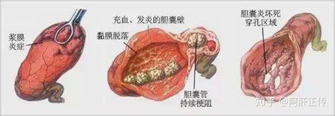 胆管结石的超声及鉴别诊断_扩张