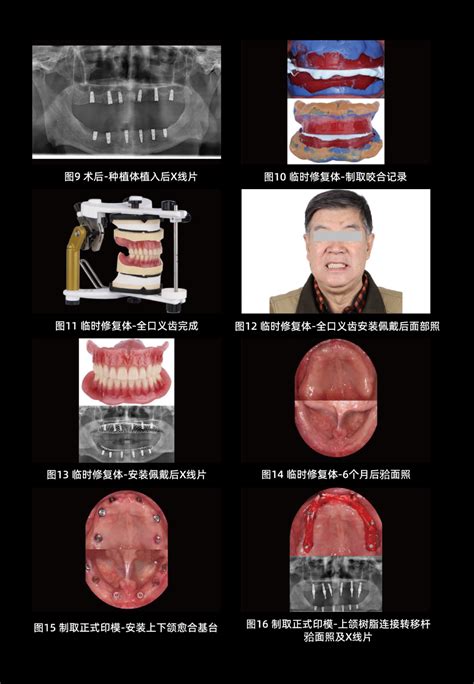 病例分享 | SKY种植体联合套筒冠附着体行全口种植覆盖义齿修复一例-bredent China