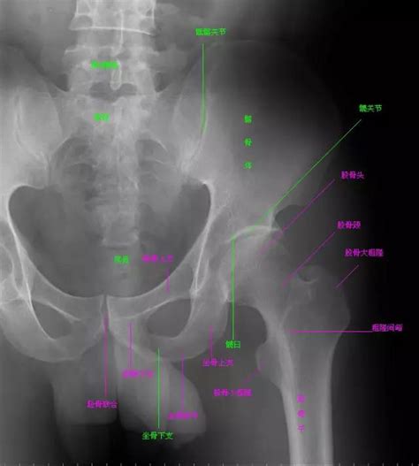 骨盆X线解剖详解三步走 - 好医术早读文章 - 好医术-赋能医生守护生命