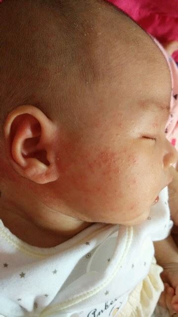 宝宝出生半个月了脸上这几天起了这些像小粉刺一样的东西，宝宝有时母乳有时喝奶粉，想知道这是什么症状该 - 百度宝宝知道