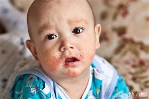 孩子吃哪些食物容易得湿疹 引起宝宝得湿疹的原因 _八宝网