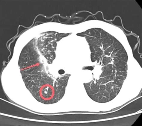 肺部CT报告上这些名词是什么意思？_健康频道_新闻中心_长江网_cjn.cn