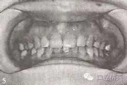 锁颌有必要矫正吗?有必要,了解完锁颌的危害有哪些便可明白 - 口腔资讯 - 牙齿矫正网