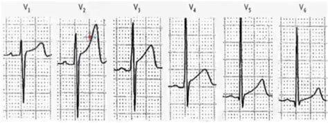 早期复极综合征的三种心电图表现，你都掌握了吗？ - 好医术早读文章 - 好医术-赋能医生守护生命