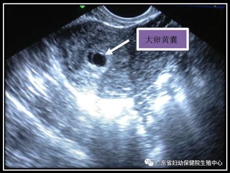 囊内可见胎芽及原始心管搏动是什么意思-有来医生