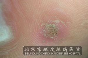 寻常疣有哪些预防的方法_寻常疣_北京京城皮肤医院(北京医保定点机构)