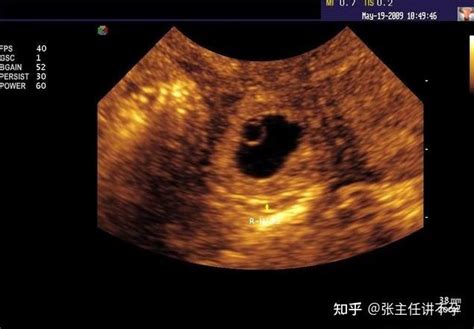 宫腔内两个卵黄囊一大一小出现双胞胎的概率大吗?_家庭医生在线