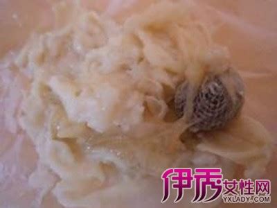 纳氏囊肿图片