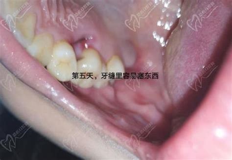 拔牙5天后牙窝愈合过程图，经过多长时间才能完全愈合呢？_皓齿口腔网