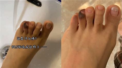 脚底发黑图片