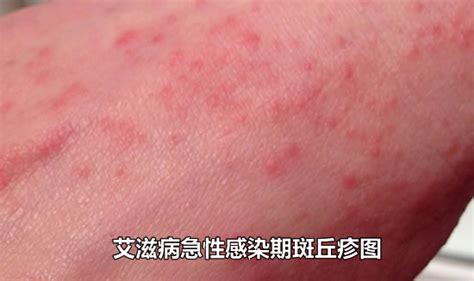 艾滋初期皮疹图片
