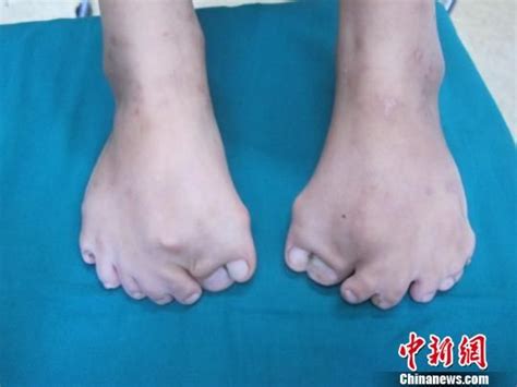 8岁女孩双脚长出15根脚趾(图)|怪病_新浪新闻