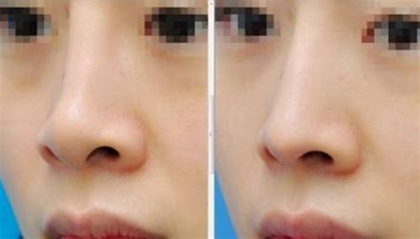 整形手术前后女鼻子对比情高清图片下载-正版图片503063366-摄图网