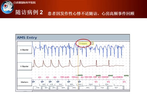 李洁：起搏器腔内电图的分析方法 课件 学术资源 心电生理 365医学网