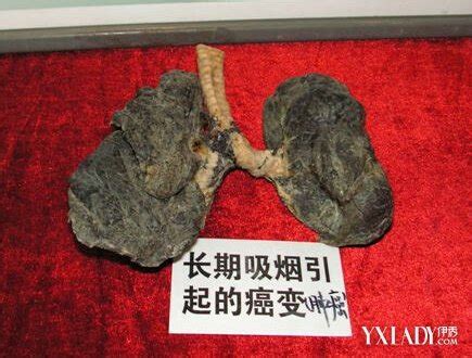 吸烟者的肺图片