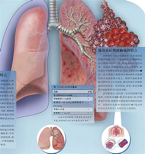 流感病毒肺炎是流感最重要的并发症之一，哪些诊断和治疗的规范必须掌握？-健康教育-清华大学附属北京清华长庚医院呼吸与危重症医学科