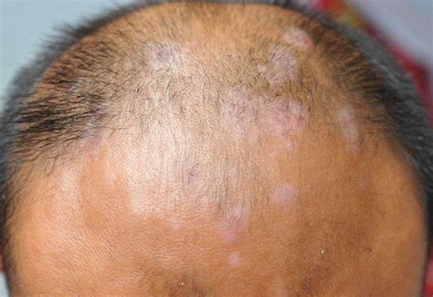 头部脂溢性皮炎是什么样子：原因症状和治疗方法-中华银屑病网