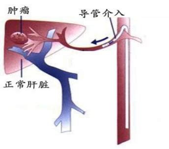 肝癌及肝转移癌的介入栓塞治疗 介入血管外科
