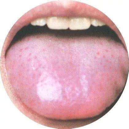 观舌识病：22种舌诊图解大全，通过舌头认识自己的身体状况_舌苔