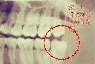 正常的智齿图片