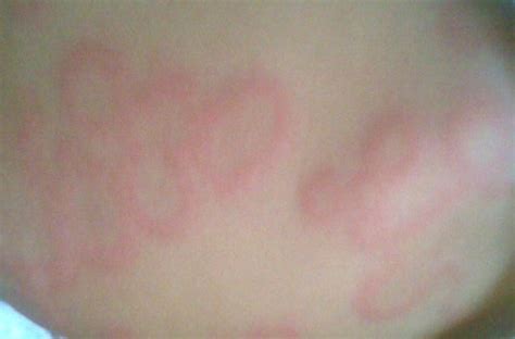 皮肤出现一个环状红圈,空心环状湿疹,身上出现圆圈斑图片_大山谷图库