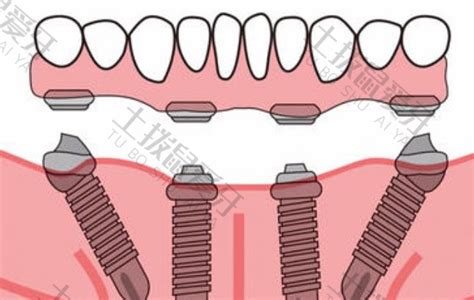 老人种植牙全口多少钱 种植牙二期手术过程_全口牙种植价格_种植牙二期手术-口腔资讯-土拨鼠爱牙