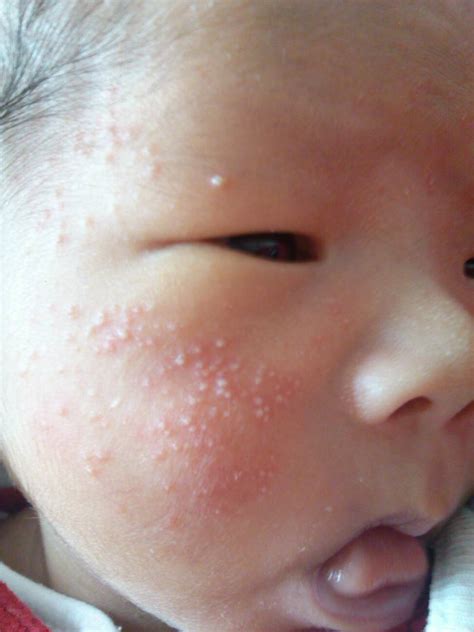 孩子总挠脸是不是痒，有一点湿疹，该怎么办 - 百度宝宝知道