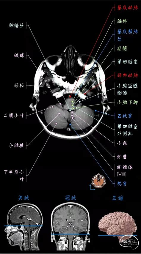 颅脑ct解剖图图片