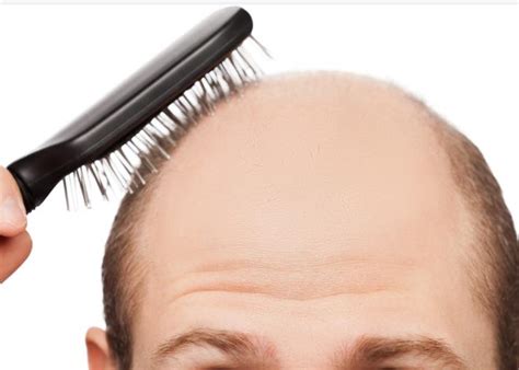 脱发自测丨如何判断是不是雄激素性脱发？ - 知乎
