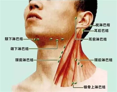 颈部淋巴结分布图图片 颈部淋巴结分布图图片