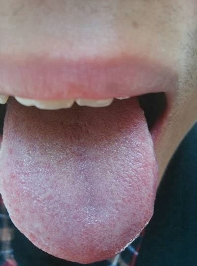舌头发紫图片 (22)_有来医生