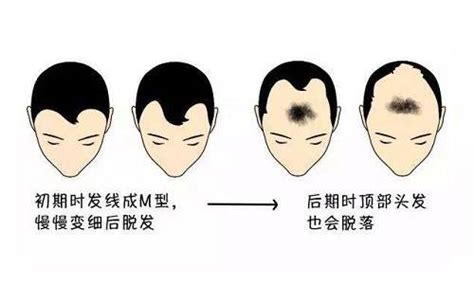 什么是雄激素性脱发？今天给大家分享几种雄激素性脱发的自测方法： - 知乎
