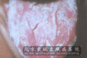 皮肤念珠菌病图片