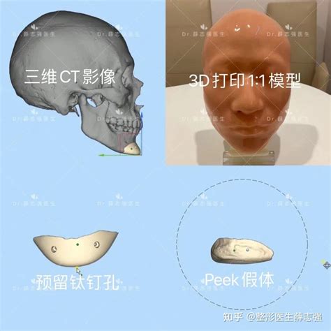3D打印数字化定制丨PEEK下巴假体改善骨性缺失 - 知乎