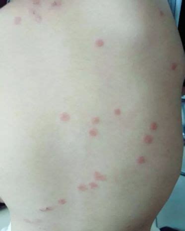100种皮肤病对照表，图解各种虫咬症状皮肤病合集(看图对比) — 神奇养生网