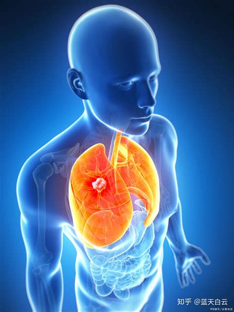 咳血一般是肺癌第几期？肺癌咳血的原因是什么？ - 知乎